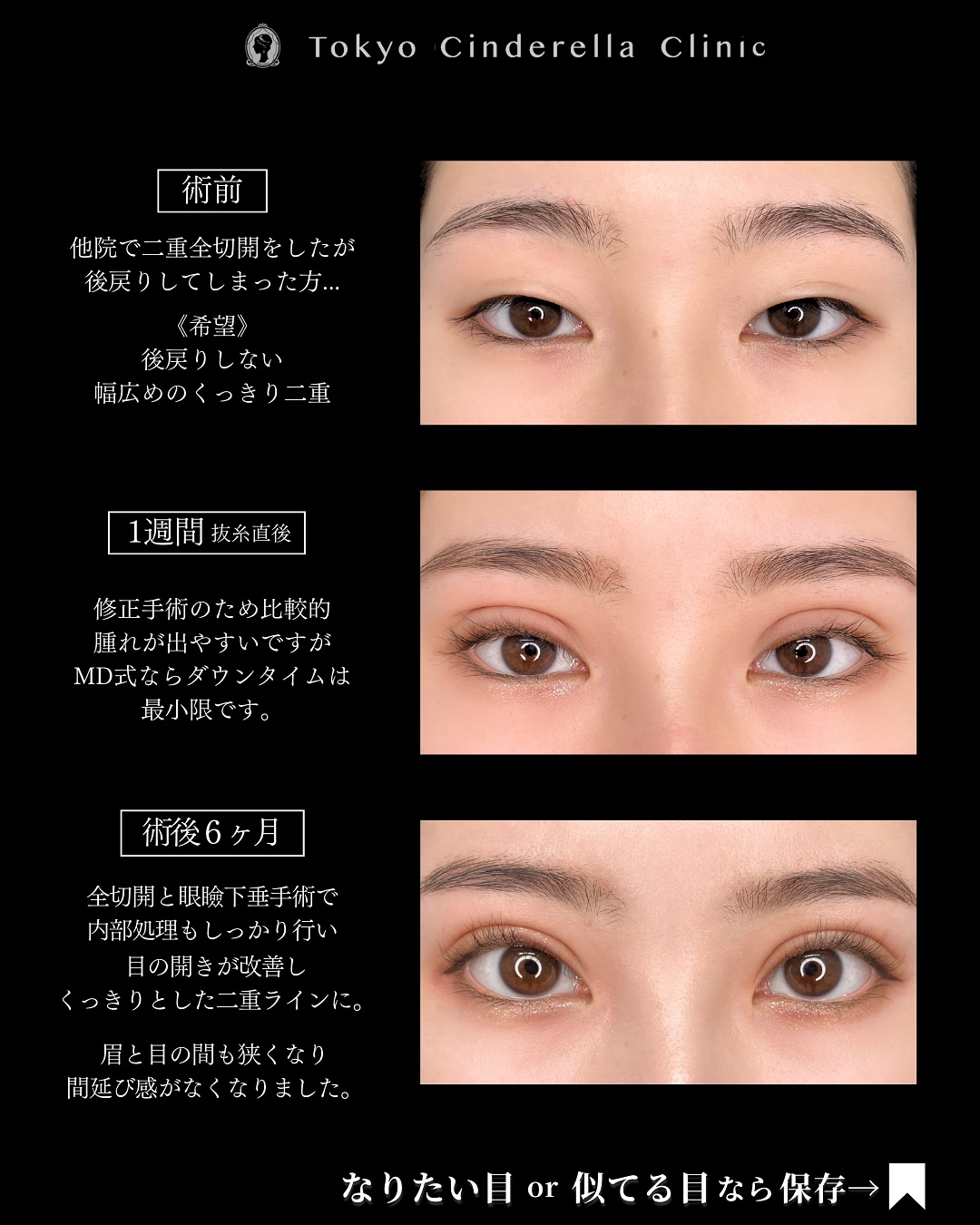全切開の他院修正手術で切開と眼瞼下垂手術を行なった方の６ヶ月までのダウンタイム