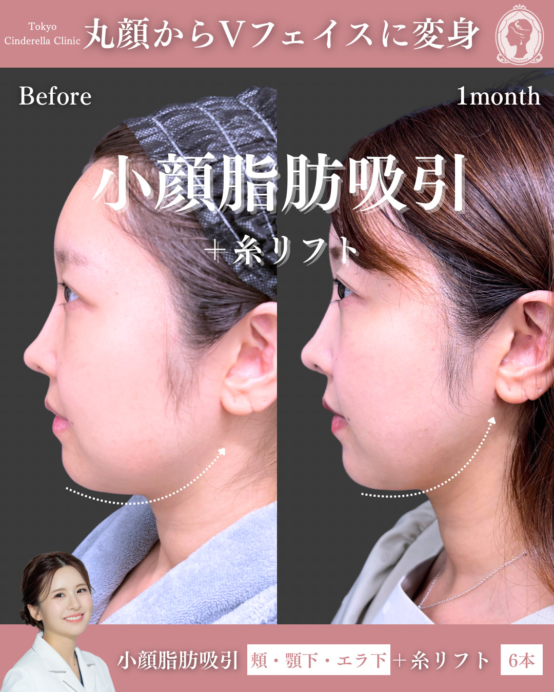 新宿院で行った脂肪吸引の名医の梅田絢乃医師の症例写真