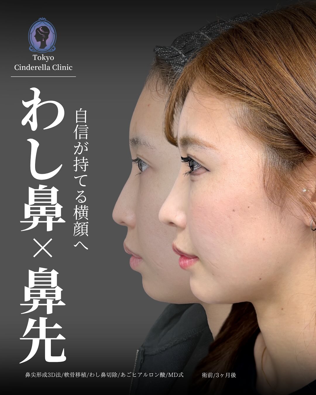 新宿院で行った鼻尖形成3D法と軟骨移植とわし鼻切除とあごのヒアルロン酸注入の3ヵ月後の症例写真