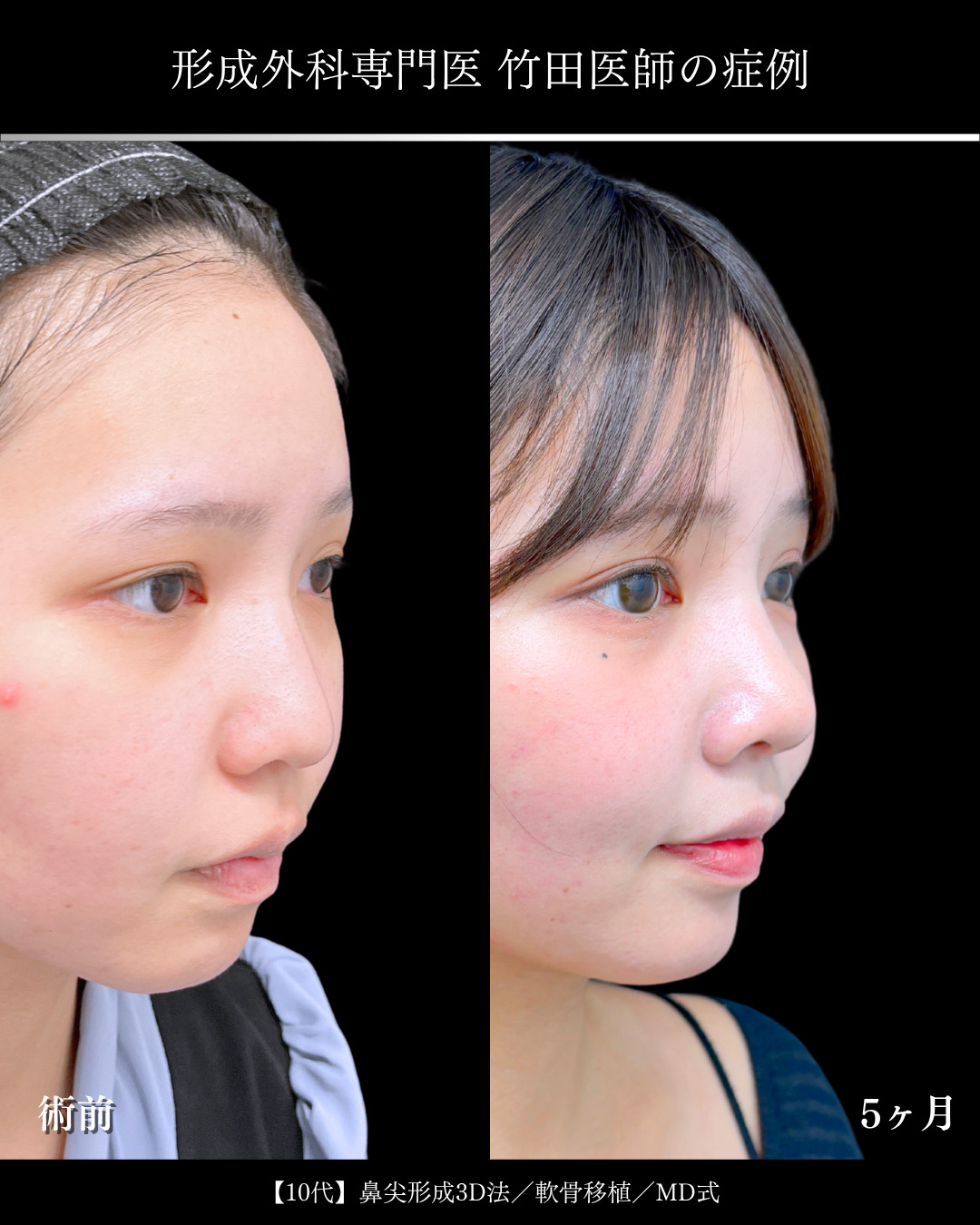 大宮院で行った鼻整形で有名な竹田昌平医師の鼻尖形成3D法と軟骨移植の症例写真