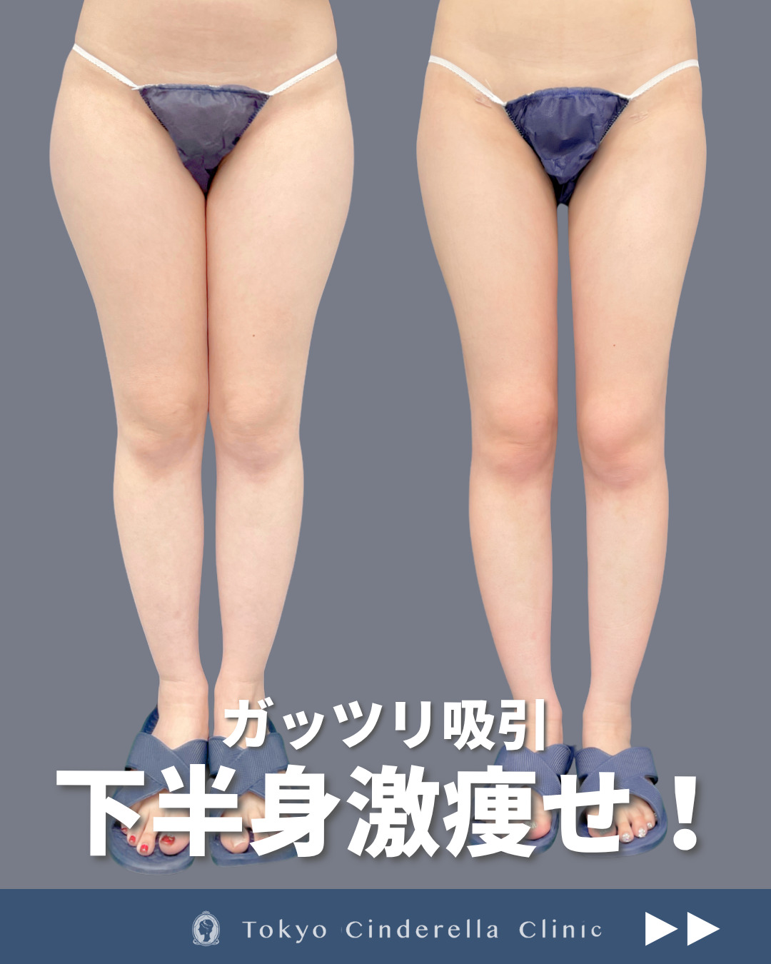 シンデレラ脂肪吸引で太ももの脂肪がなくなり隙間ができた方の１ヶ月症例