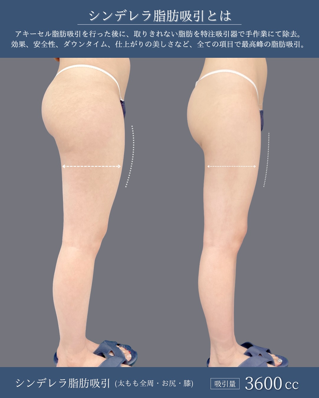 新宿院で行った太ももとお尻と膝のシンデレラ脂肪吸引の1ヶ月後のダウンタイム症例