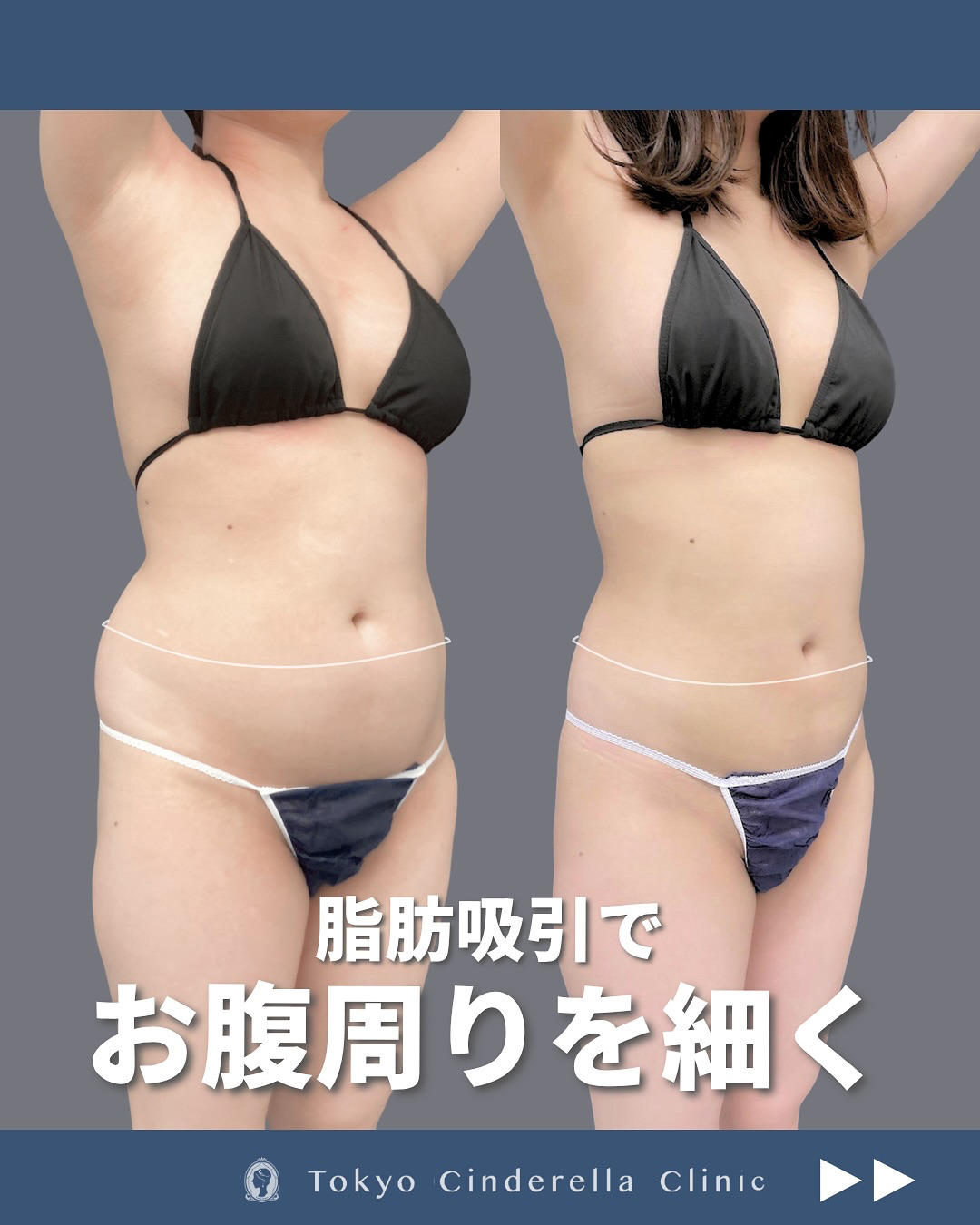 新宿院で行ったお腹とウエストと腰のアキーセル脂肪吸引の1ヶ月後の症例写真