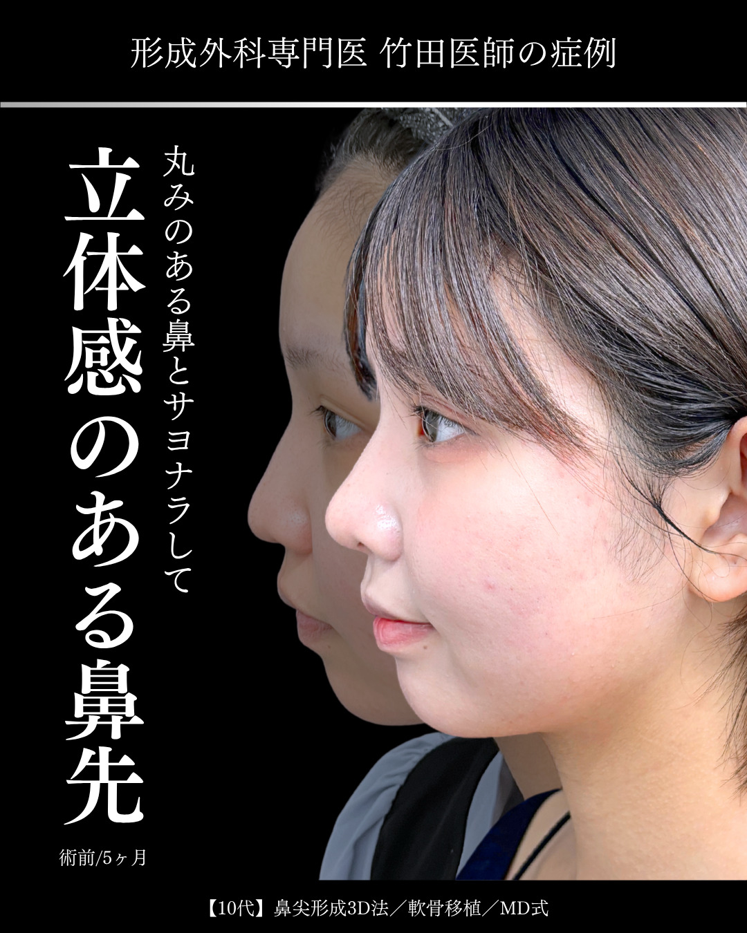 大宮院で行った鼻整形で有名な竹田昌平医師の鼻尖形成3D法と軟骨移植の症例写真