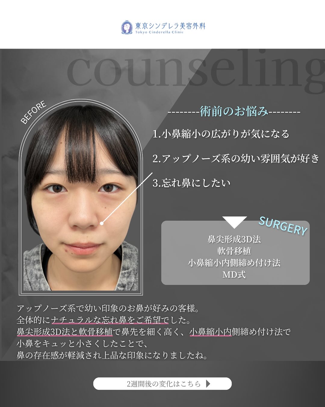 新宿院で行った鼻整形で有名な吉原伯医師のMD式の鼻尖形成3D法と軟骨移植と小鼻縮小内側締め付け法の2週間後の症例写真