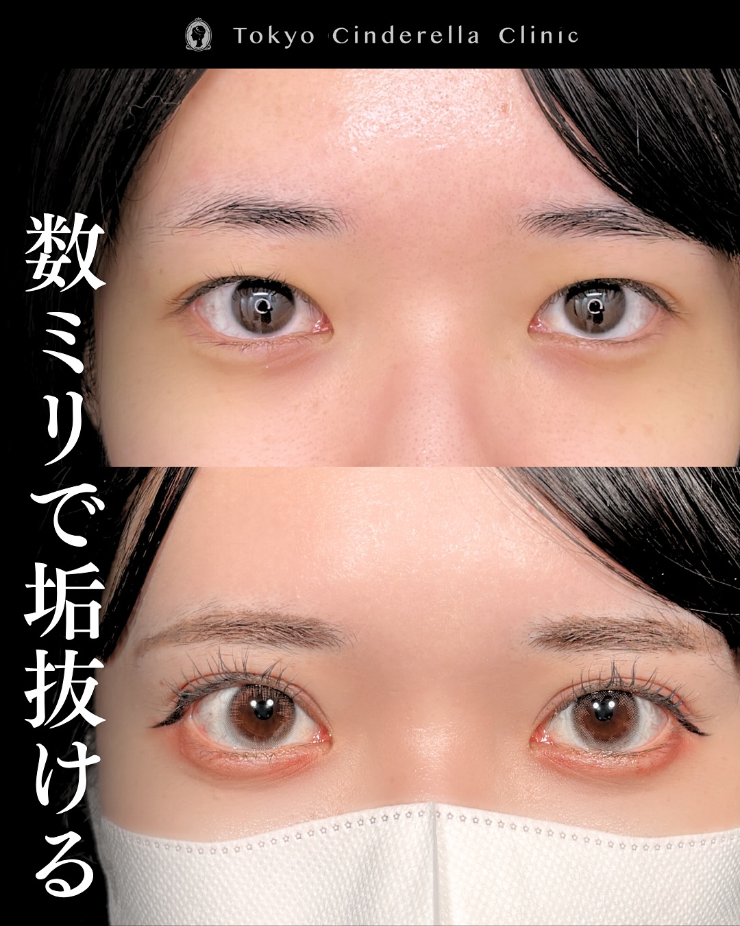 新宿院で行った二重整形で有名な吉原伯医師のMD式のたるみ取り併用全切開法二重術と眼瞼下垂手術の1年後の症例写真