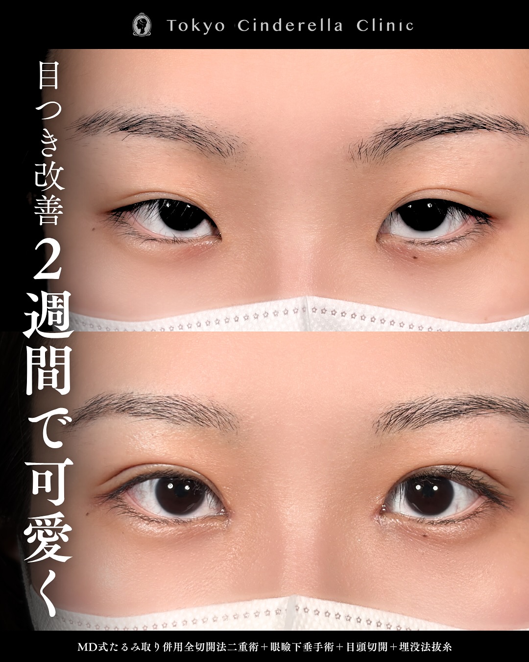 新宿院で行った二重整形で有名な吉原伯医師のMD式のたるみ取り併用全切開法二重術と眼瞼下垂手術と埋没方抜糸の2週間後のダウンタイム症例写真