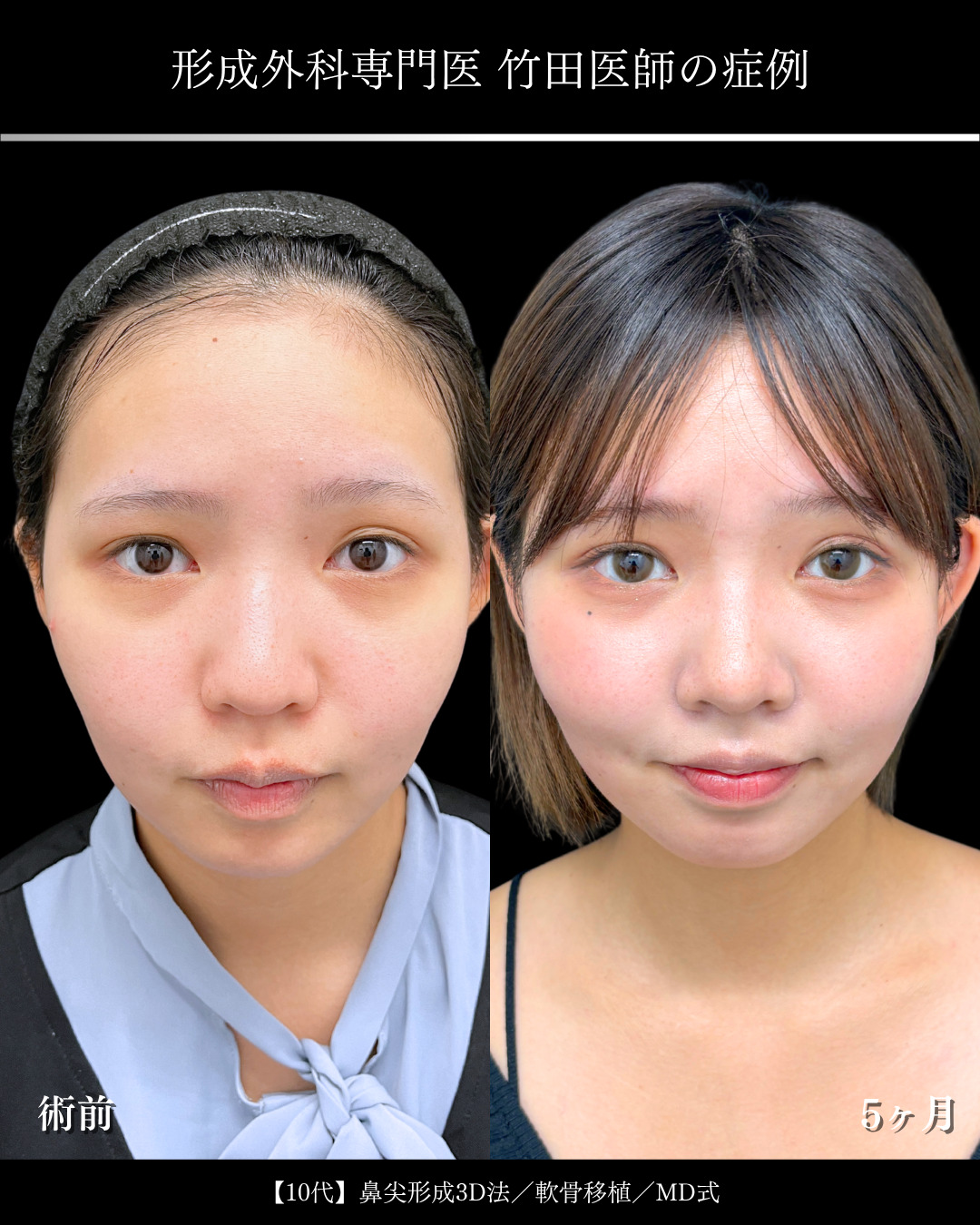 大宮院で行った鼻整形で有名な竹田昌平医師の鼻尖形成3D法と軟骨移植の症例写真