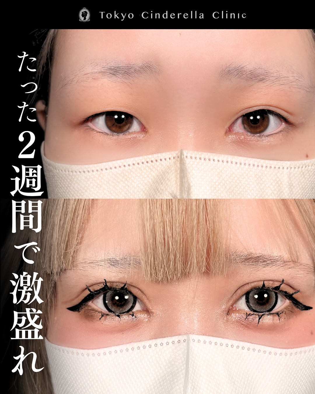 新宿院で二重切開と眼瞼下垂と目頭切開を行った2週間後のダウンタイム症例