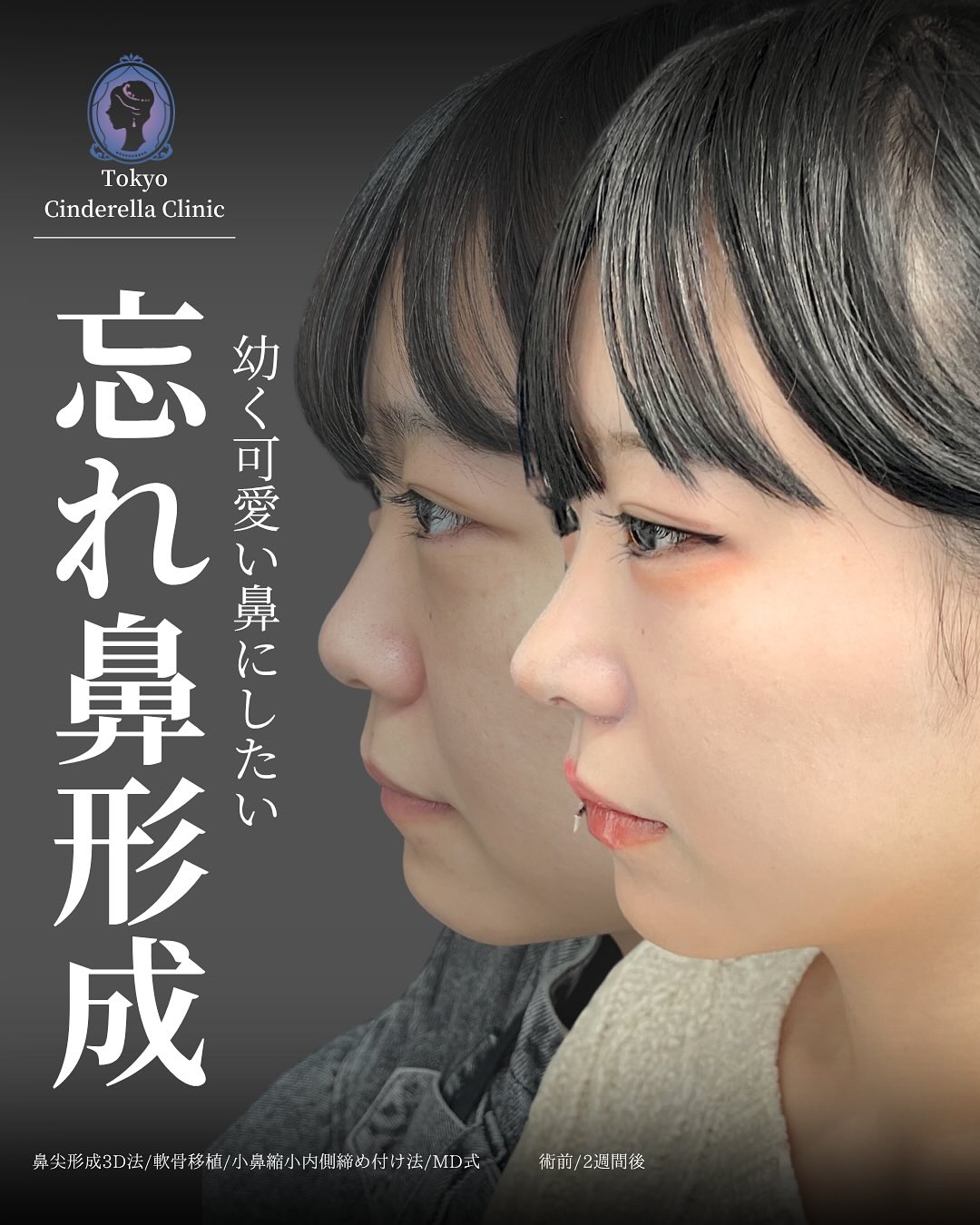 新宿院で行った鼻整形で有名な吉原伯医師のMD式の鼻尖形成3D法と軟骨移植と小鼻縮小内側締め付け法の2週間後の症例写真