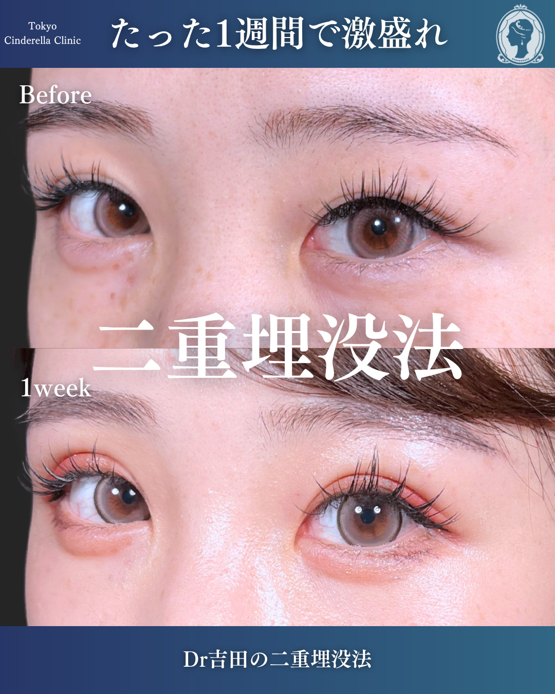 新宿院で行った二重埋没法の名医の吉田利之医師の症例写真