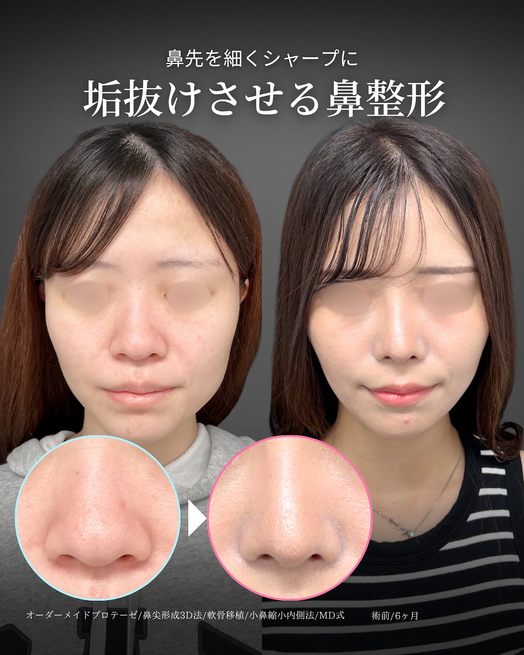 新宿院で行ったMD式鼻尖形成3D法と軟骨移植とオーダーメイドプロテーゼと小鼻縮小内側締め付け法の6ヵ月後の症例写真