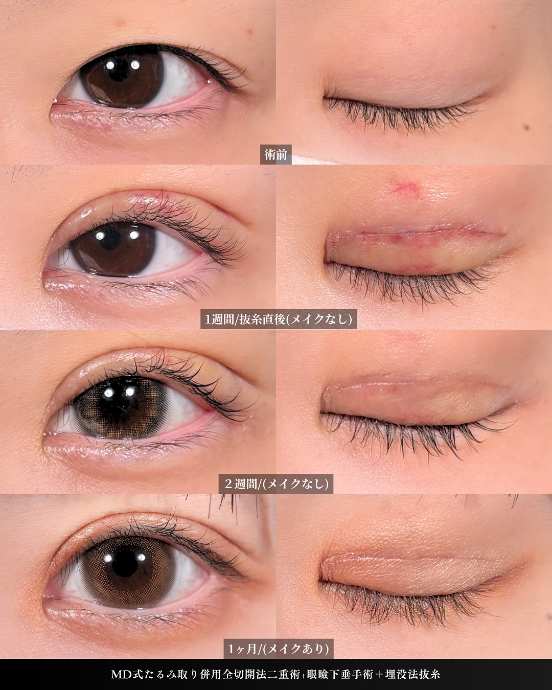 新宿院で行った二重整形で有名な吉原伯医師のMD式のたるみ取り併用全切開法二重術と眼瞼下垂手術の1ヵ月までのダウンタイム症例写真