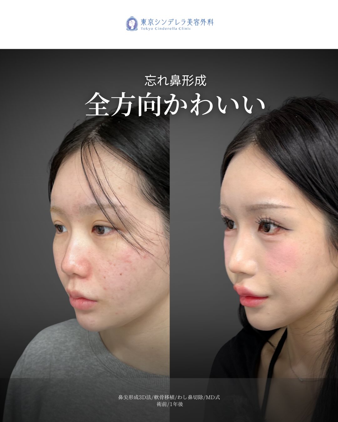 新宿院で行ったMD式の鼻尖形成3D法と軟骨移植とわし鼻切除との1年後の症例写真