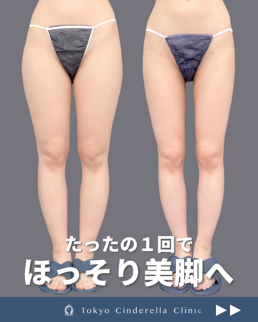 新宿院で行った太ももとお尻と膝のアキーセル脂肪吸引の3ヶ月後の症例写真