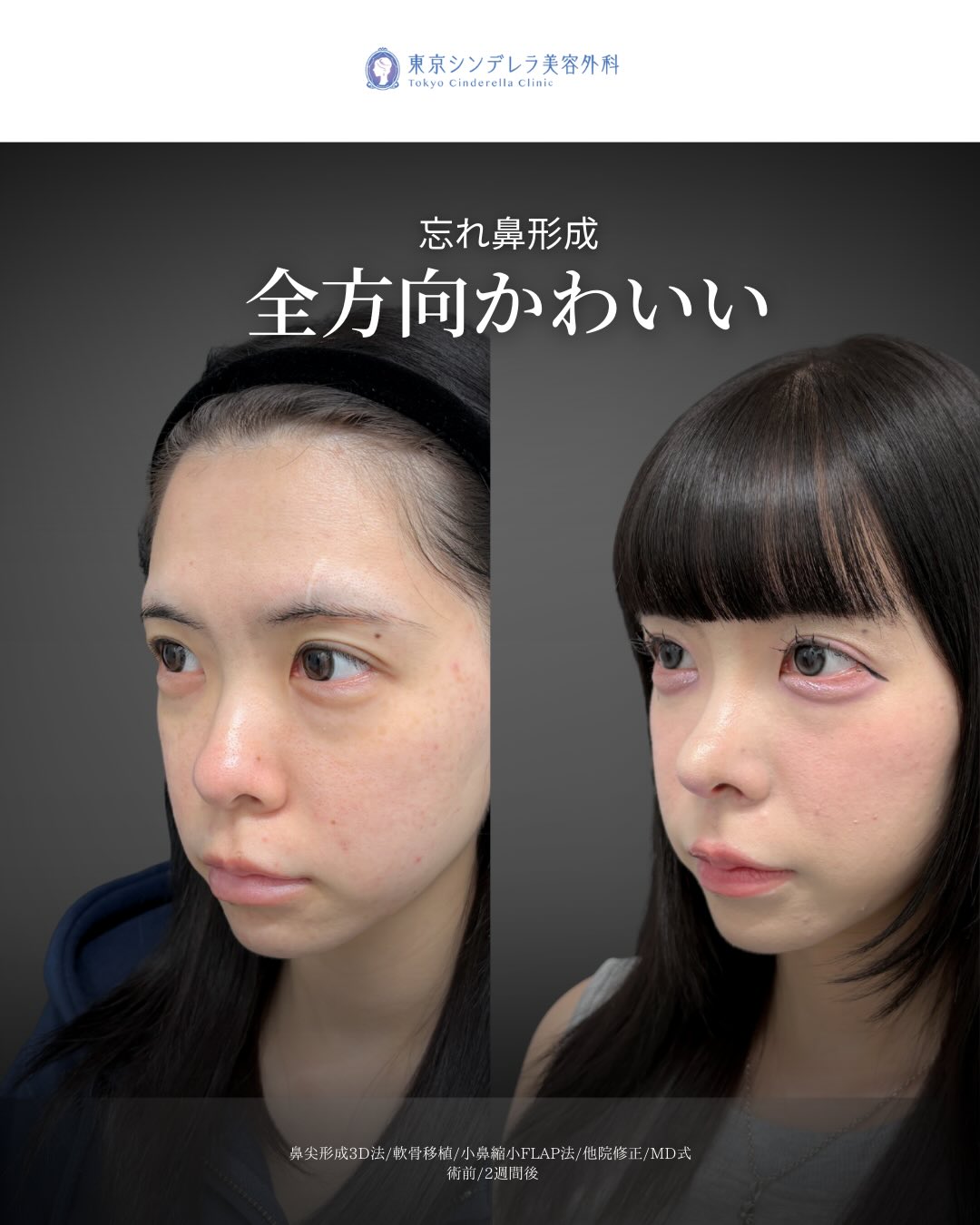 新宿院で行った鼻尖形成3D法と軟骨移植と小鼻縮小FLAP法と他院修正の2週間後の症例写真
