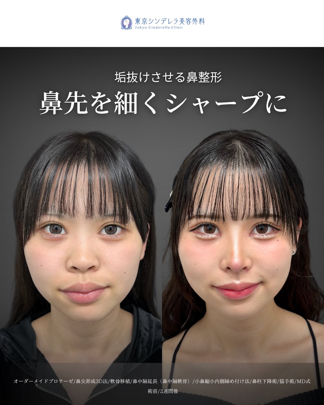 新宿院で行った鼻尖形成3D法と軟骨移植と鼻中隔延長と小鼻縮小内側締め付け法と鼻柱下降術と猫手術の鼻フル整形を行い口元の突出感が改善された2週間後の症例写真