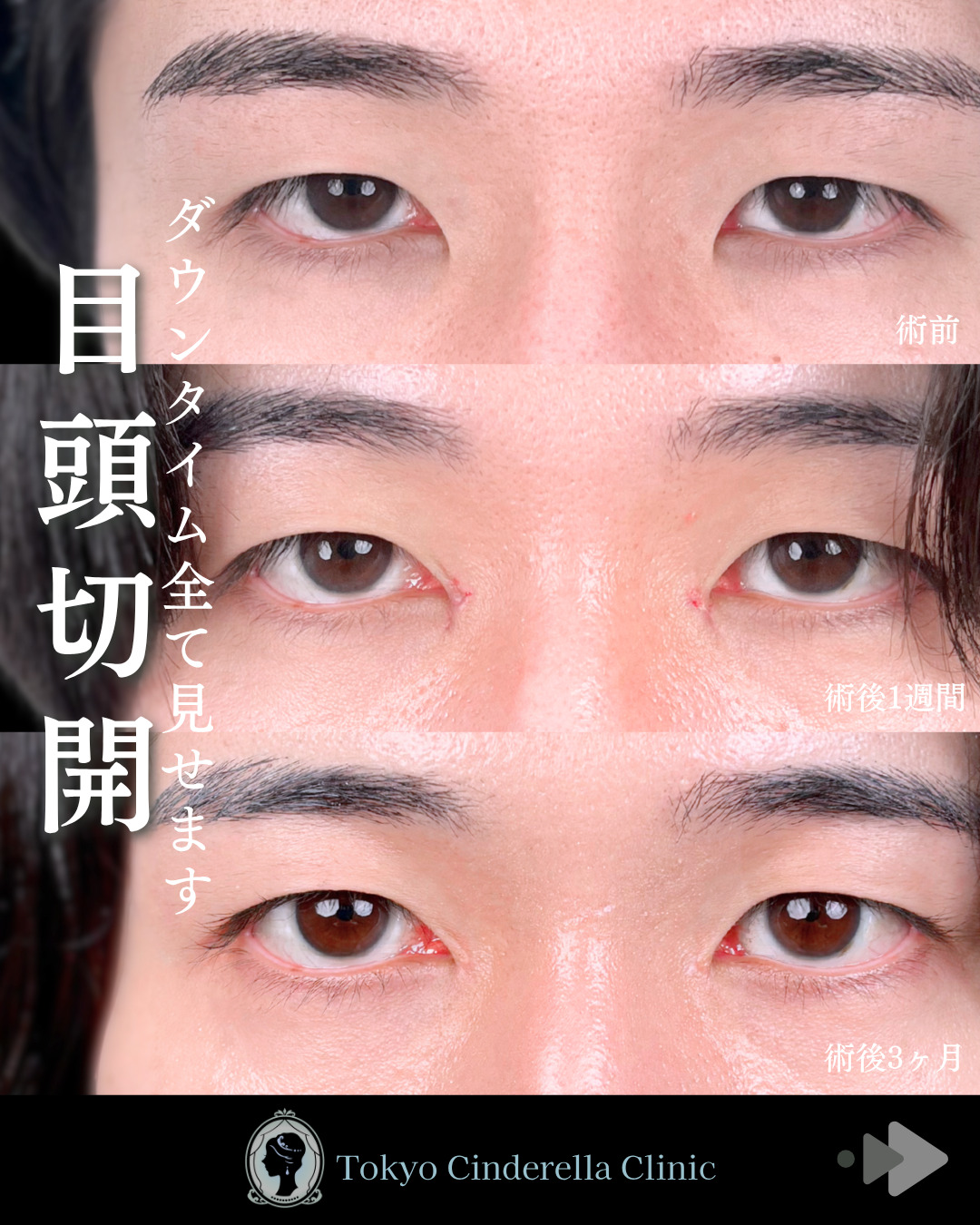 池袋院で行ったMD式目頭切開整形で有名な名医の石井達也の症例写真