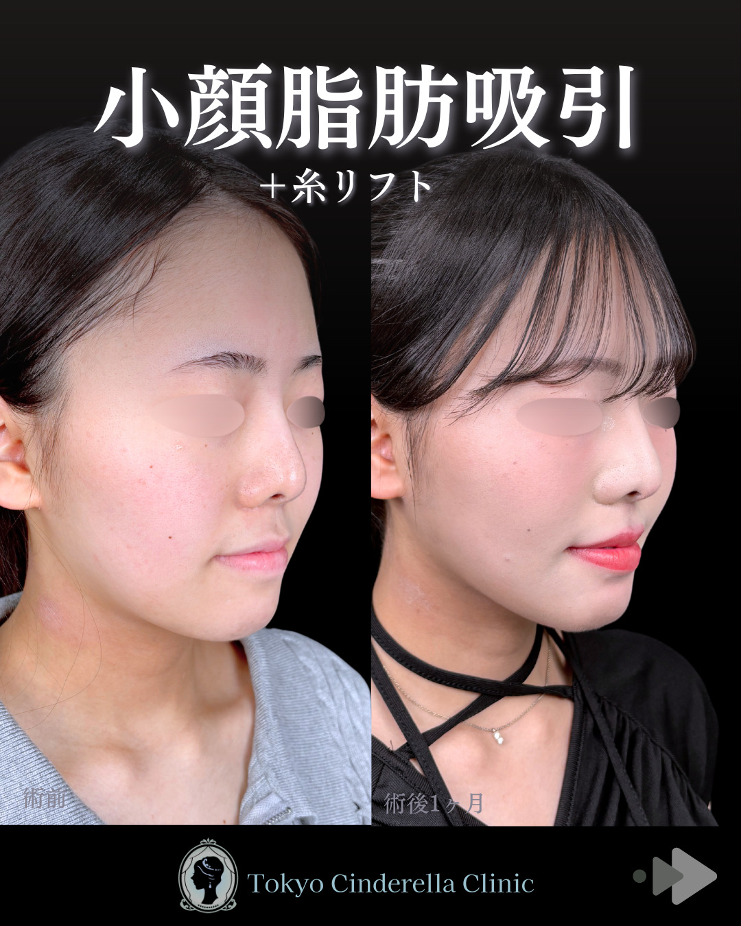 池袋院で行ったアキーセル脂肪吸引(頬・あご下・エラ下・ジョールファット) とクイックリフト12本整形で有名な名医の石井達也の症例写真