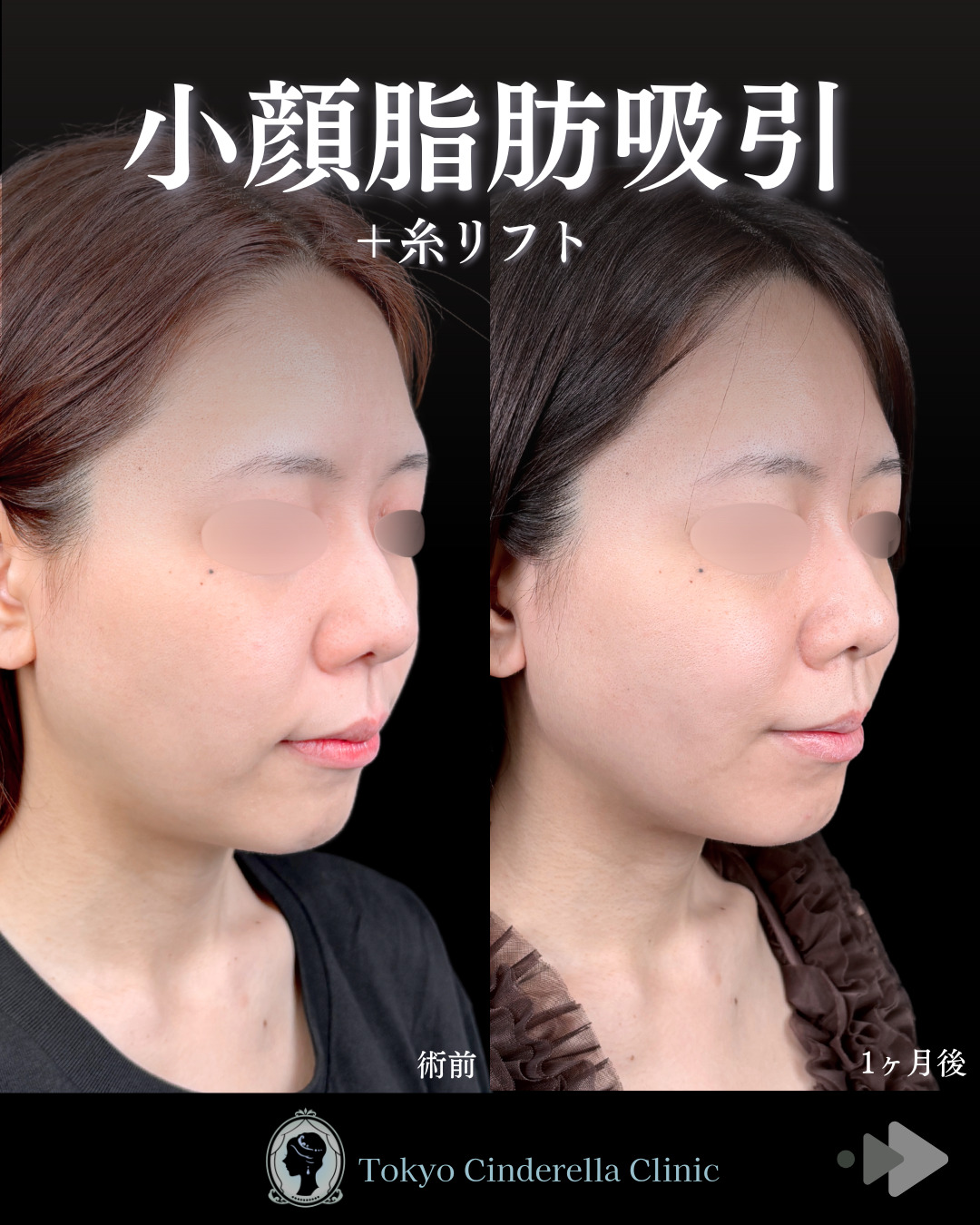 池袋院で行った小顔脂肪吸引(頬・あご下・エラ下・ジョールファット) と糸リフト整形で有名な名医の石井達也の症例写真