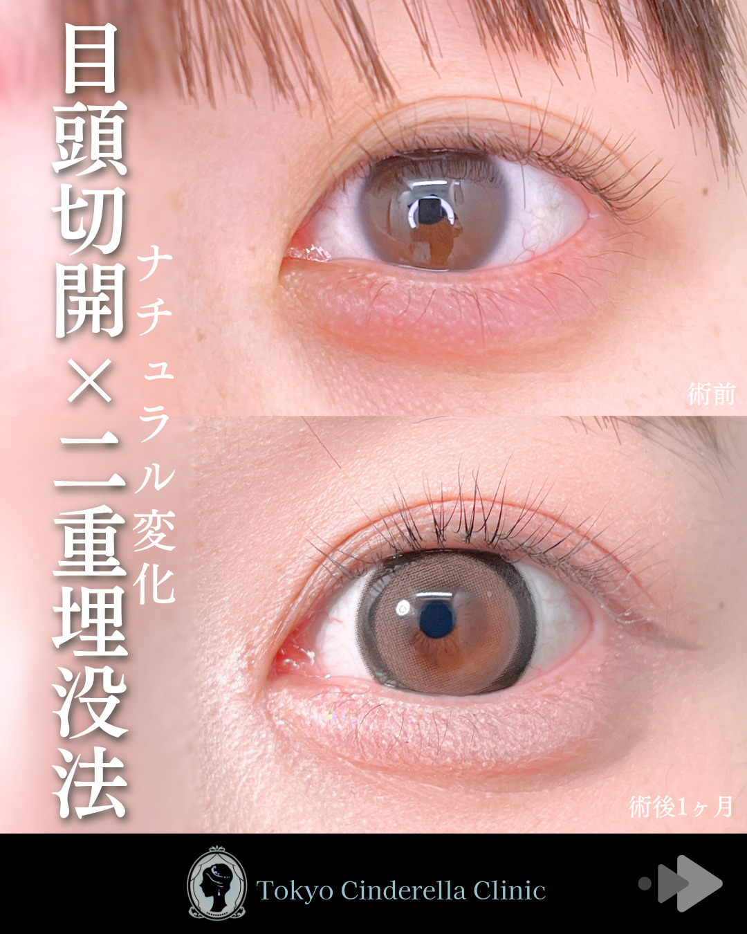 池袋院で行ったクイックシンデレラ・ダブルとMD式目頭切開整形で有名な名医の石井達也の症例写真