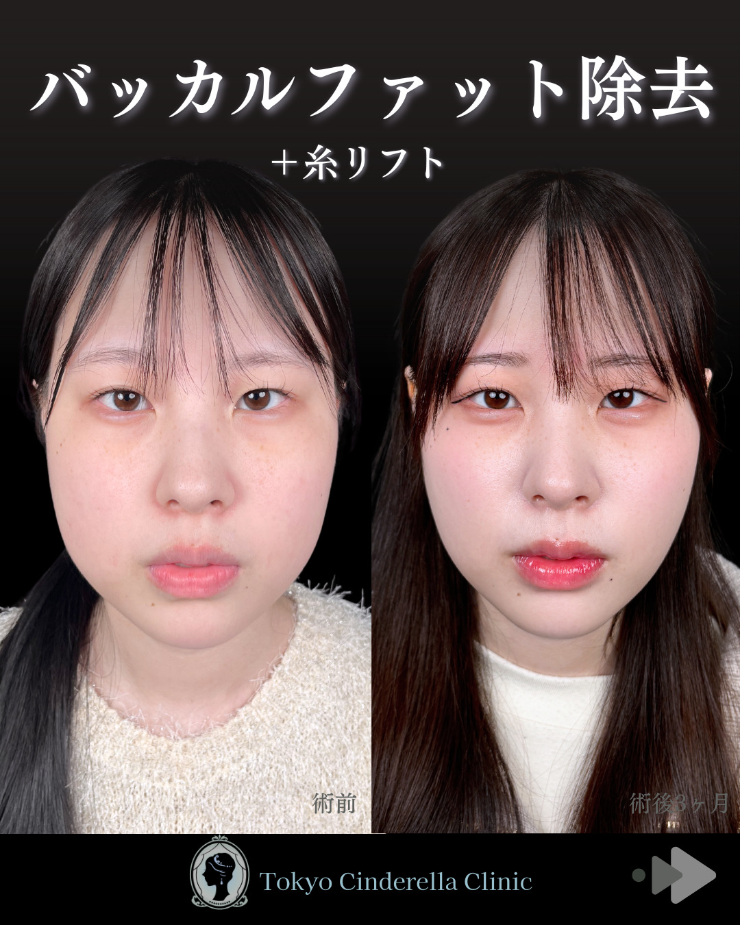 池袋院で行ったバッカルファット除去とクイックリフト 8本整形で有名な名医の石井達也の症例写真