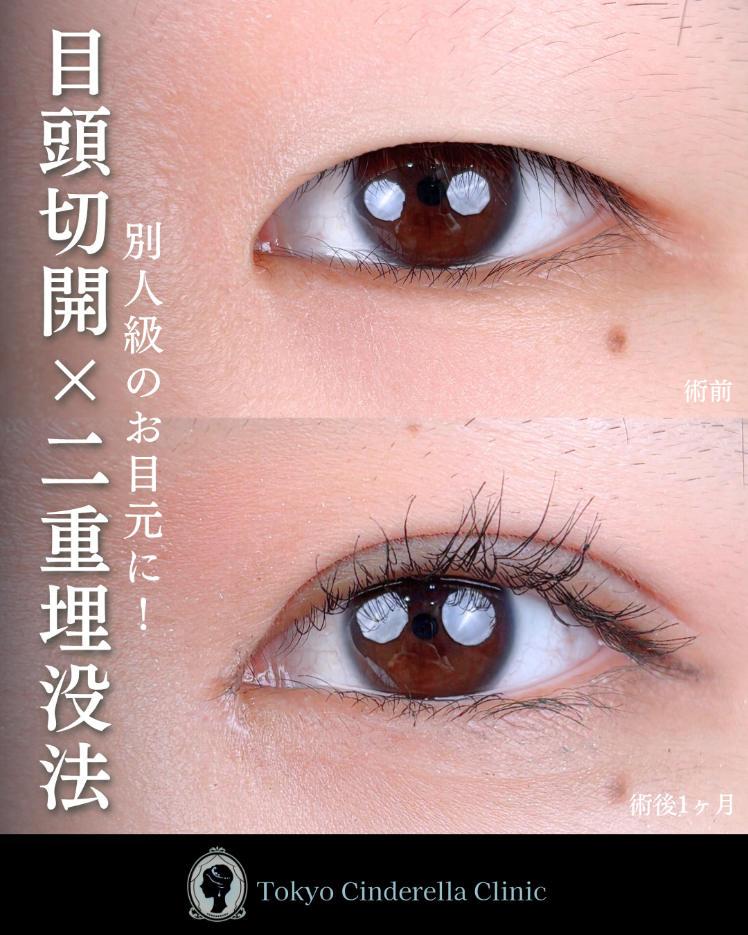 池袋院で行った韓国式自然癒着法6点と目頭切開整形で有名な名医の石井達也の症例写真