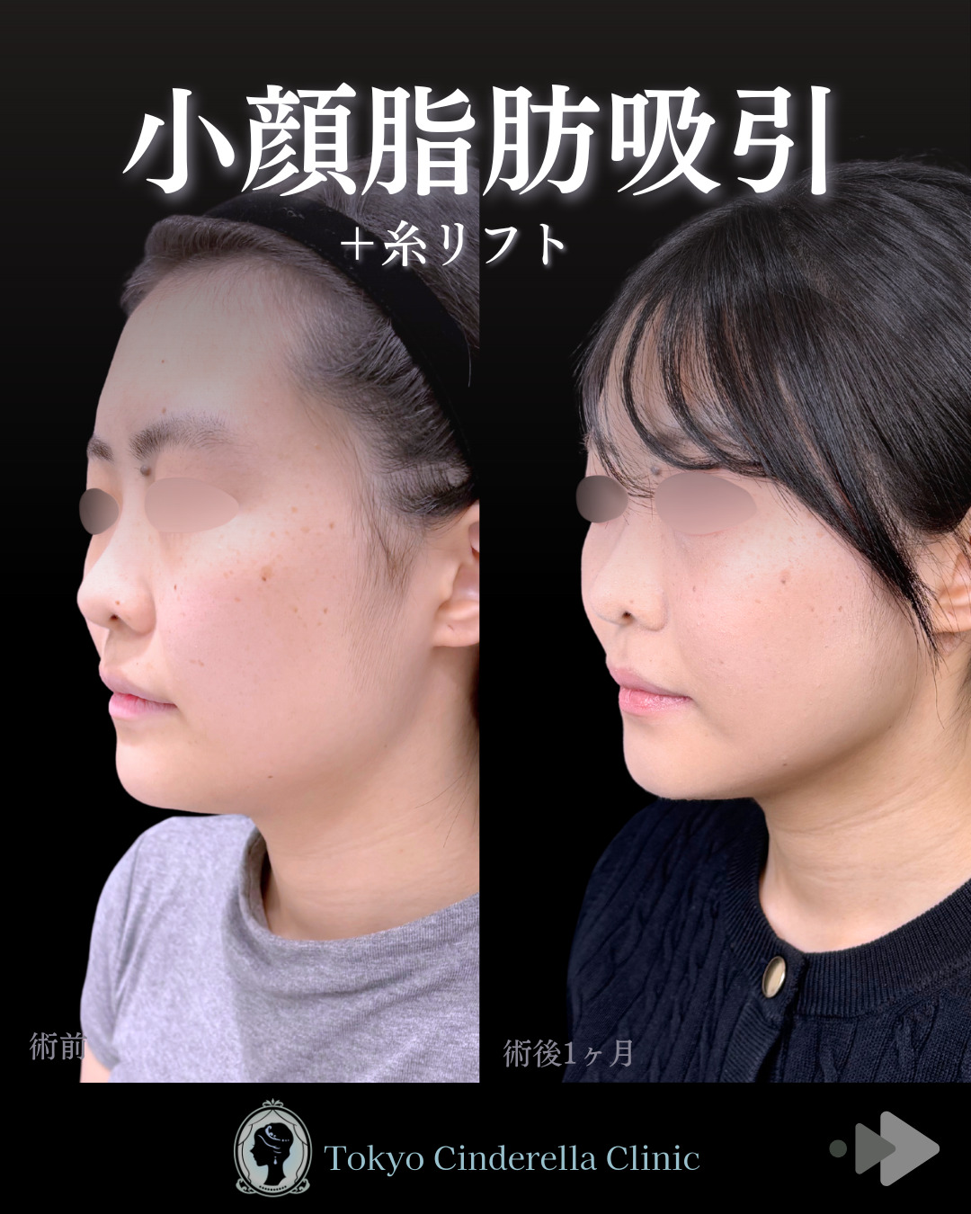池袋院で行ったアキーセル小顔脂肪吸引(頬・あご下・エラ下・ジョールファット) と糸リフト8本整形で有名な名医の石井達也の症例写真