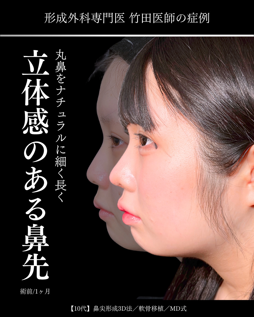 大宮院で行った鼻整形で有名な竹田昌平医師のMD式の鼻尖形成3D法と軟骨移植の症例写真