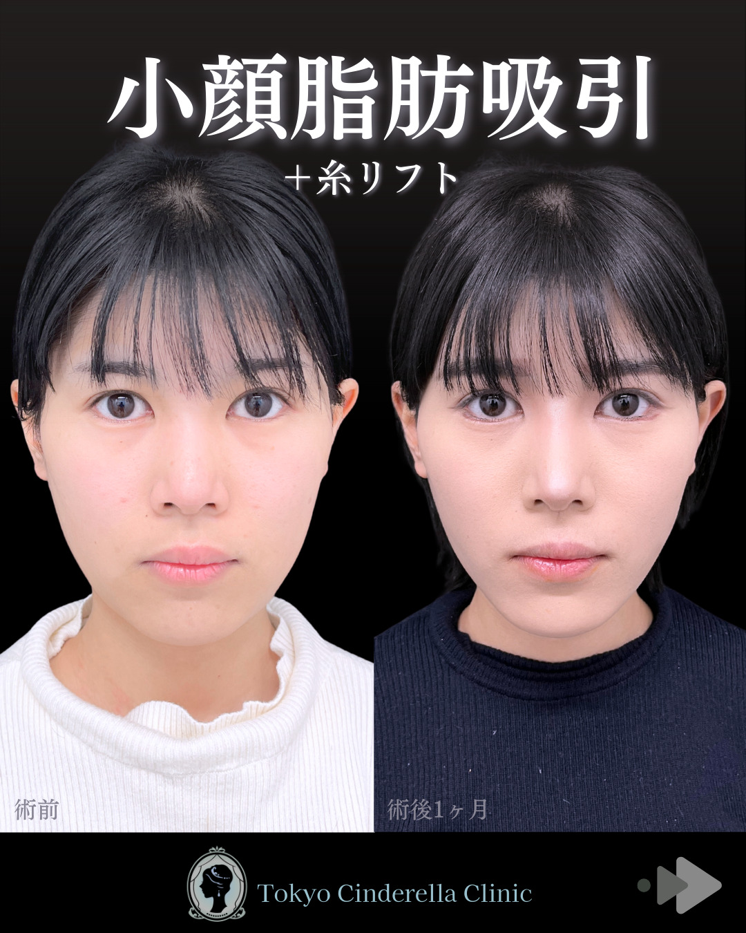 池袋院で行った小顔脂肪吸引(頬・あご下・エラ下・ジョールファット) とクイックリフト10本整形で有名な名医の石井達也の症例写真