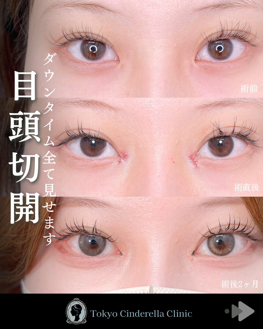 池袋院で行ったMD式目頭切開整形で有名な名医の石井達也の症例写真