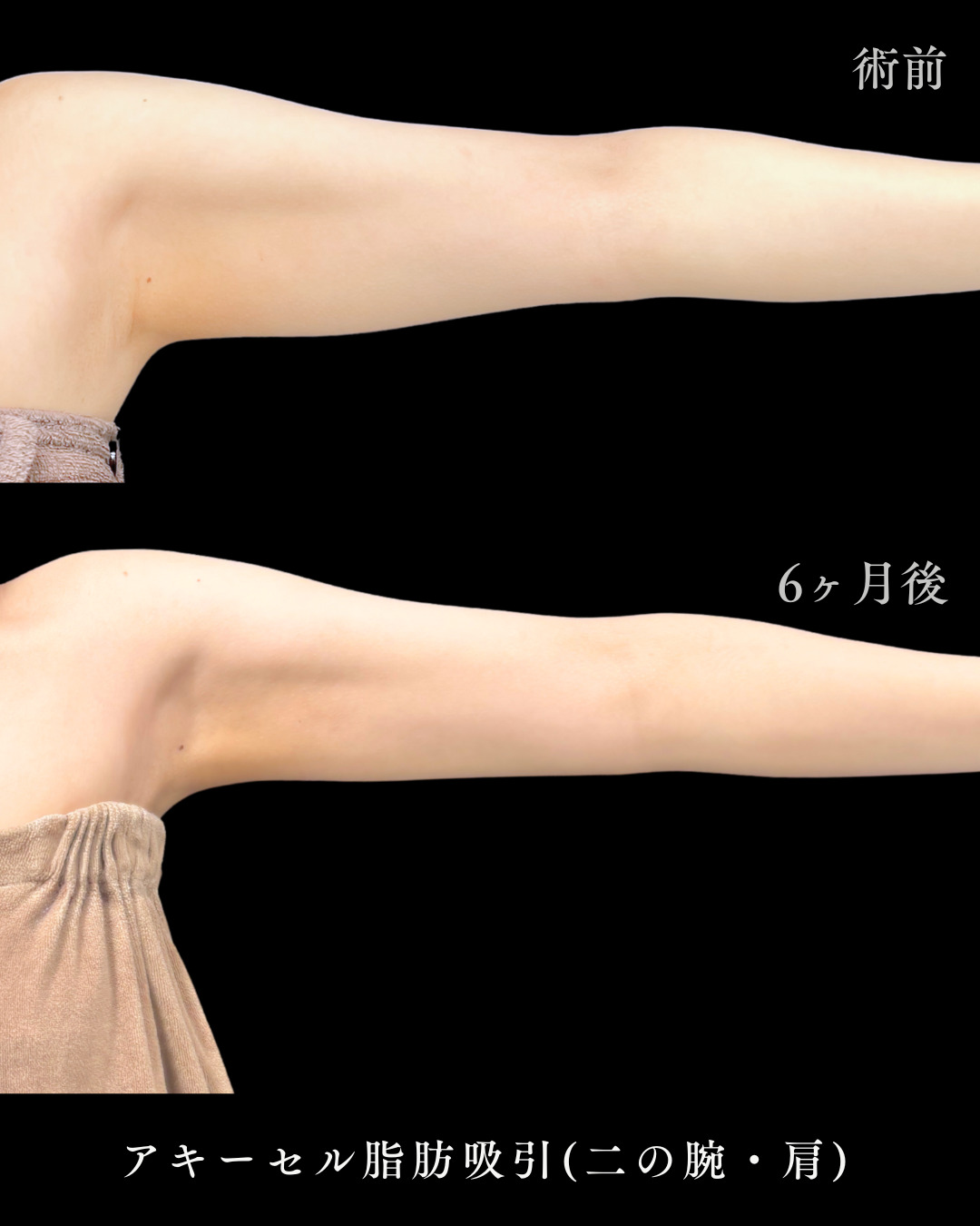 池袋院で行ったアキーセル脂肪吸引(二の腕・肩)とボツリヌス注射(肩)整形で有名な名医の石井達也の症例写真