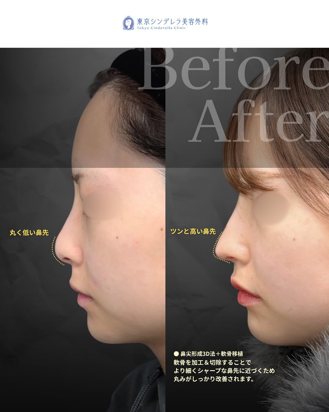 新宿院で行った鼻尖形成3D法と軟骨移植の2週間後の症例写真