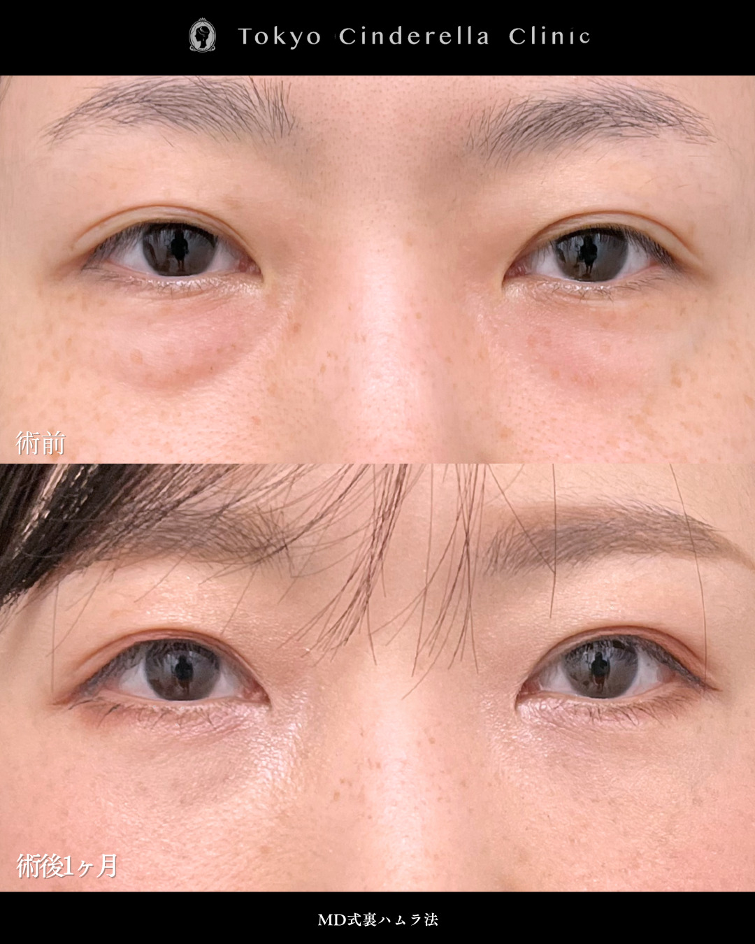 裏ハムラ法で目の下の膨らみが改善し若々しい目元になった40代の1ヶ月症例