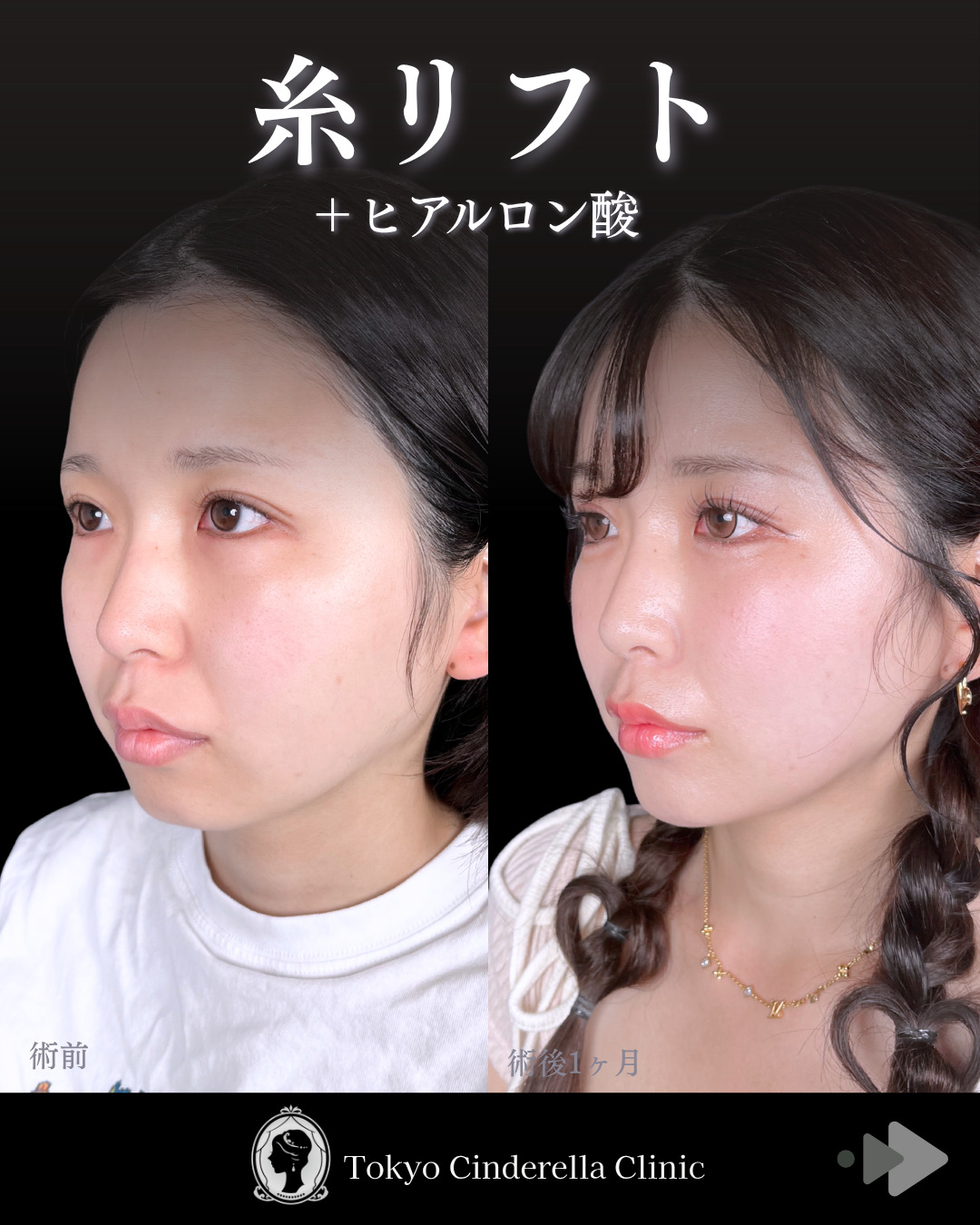 池袋院で行ったクイックリフト8本とヒアルロン酸（ほうれい線基部・あご）整形で有名な名医の石井達也の症例写真