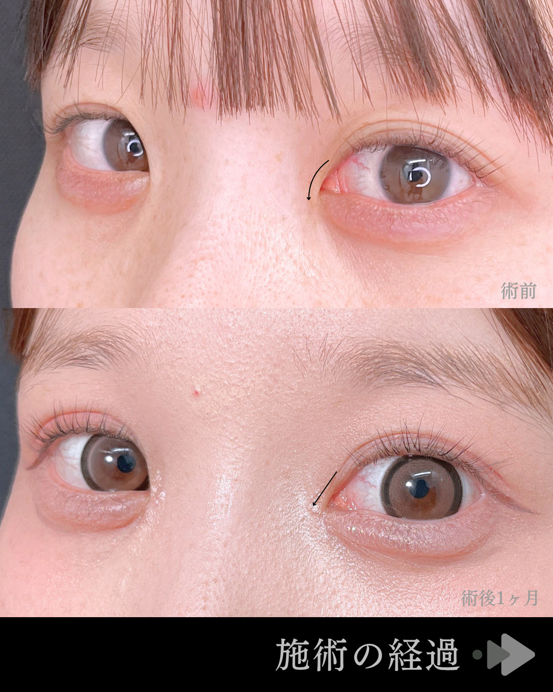 池袋院で行ったクイックシンデレラ・ダブルとMD式目頭切開整形で有名な名医の石井達也の症例写真