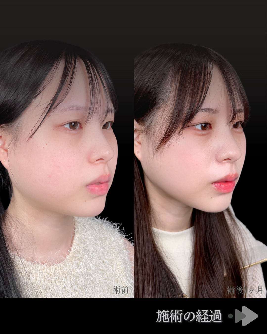 池袋院で行ったバッカルファット除去とクイックリフト 8本整形で有名な名医の石井達也の症例写真
