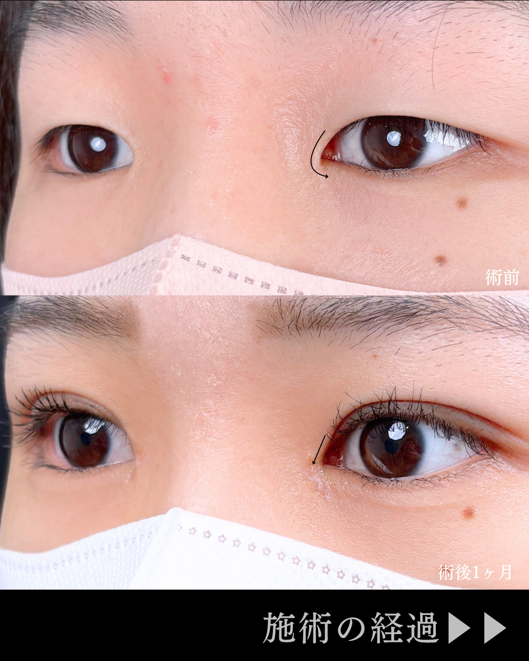 池袋院で行った韓国式自然癒着法6点と目頭切開整形で有名な名医の石井達也の症例写真