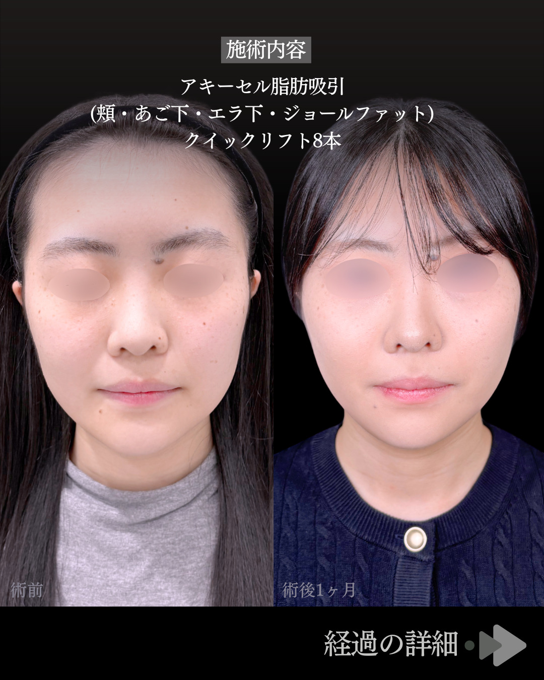 池袋院で行ったアキーセル小顔脂肪吸引(頬・あご下・エラ下・ジョールファット) と糸リフト8本整形で有名な名医の石井達也の症例写真
