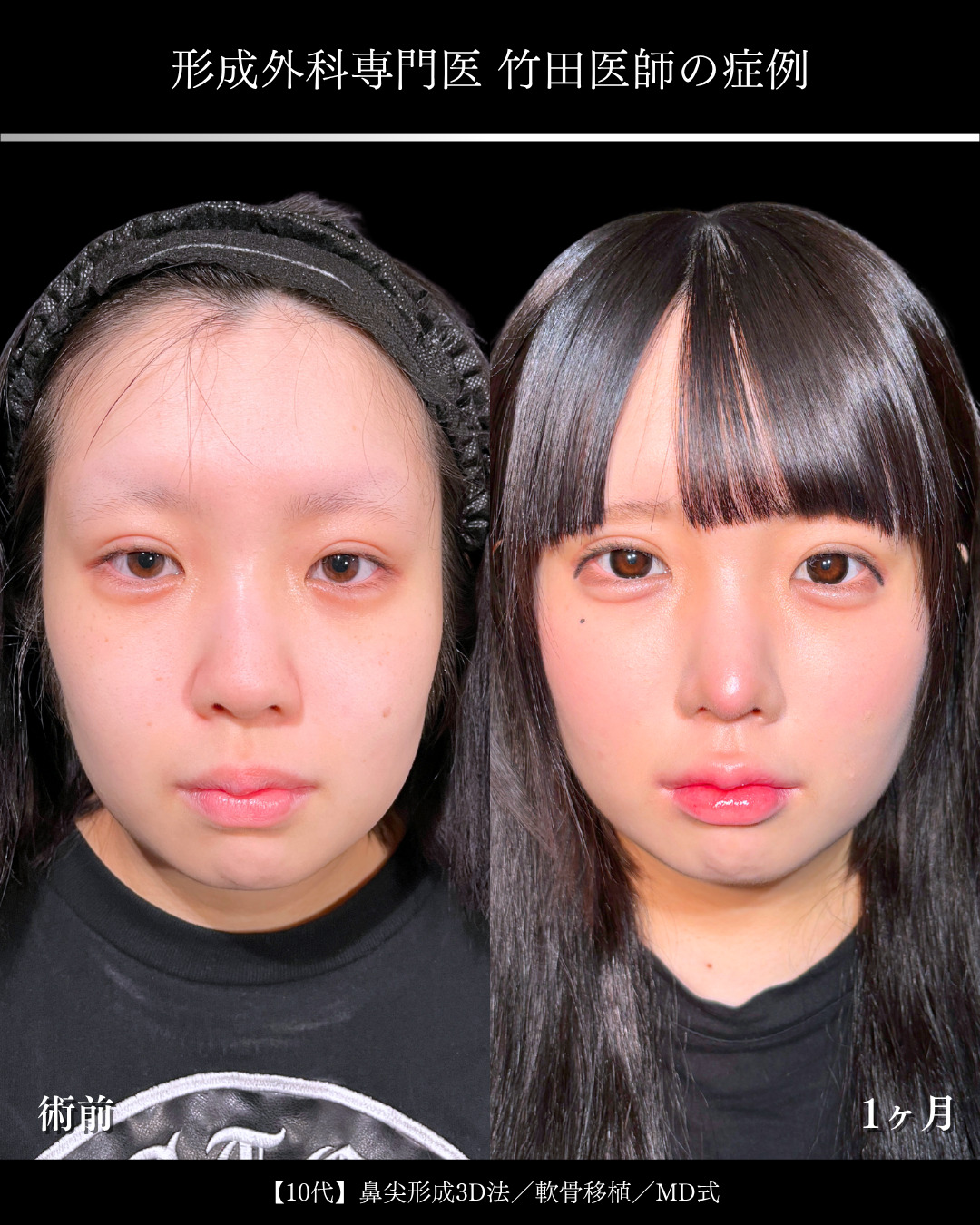 大宮院で行った鼻整形で有名な竹田昌平医師のMD式の鼻尖形成3D法と軟骨移植の症例写真