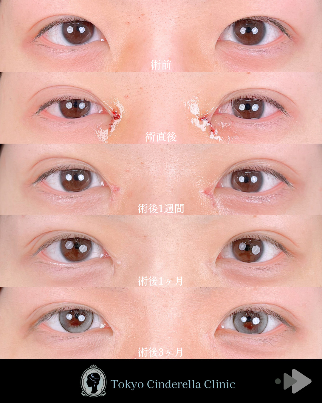 池袋院で行った目頭切開とクイックシンデレラ・ダブル整形で有名な名医の石井達也の症例写真