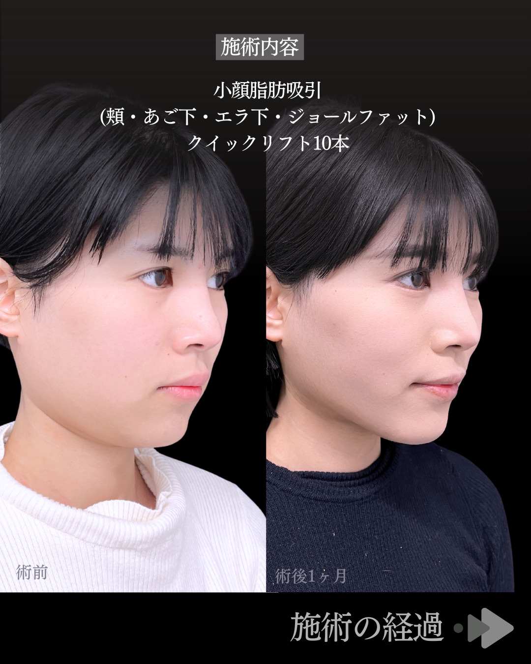 池袋院で行った小顔脂肪吸引(頬・あご下・エラ下・ジョールファット) とクイックリフト10本整形で有名な名医の石井達也の症例写真