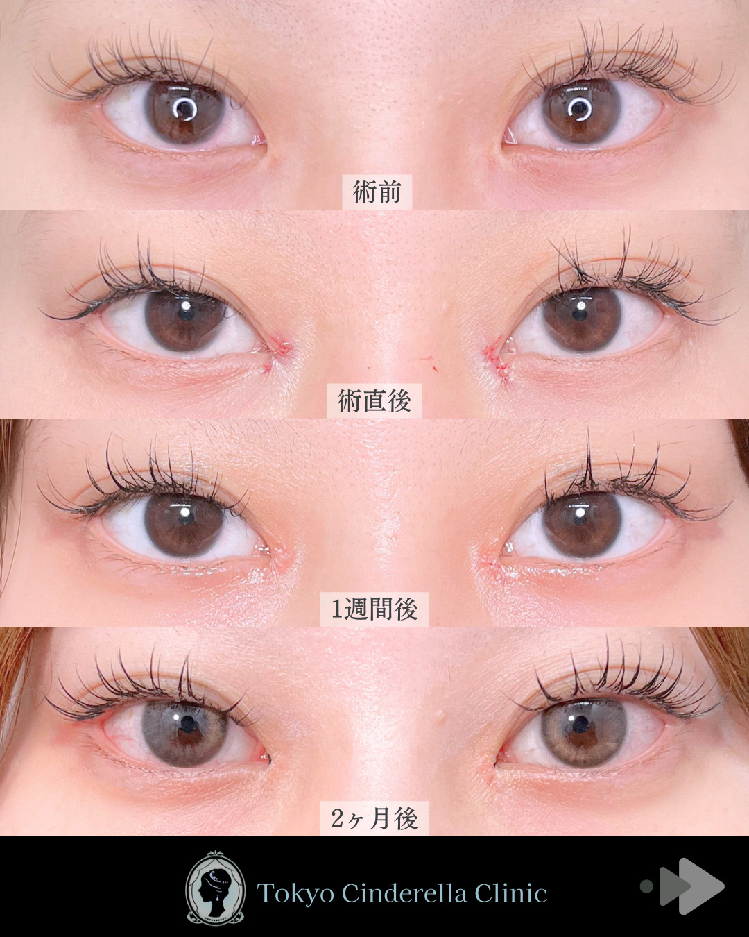 池袋院で行ったMD式目頭切開整形で有名な名医の石井達也の症例写真