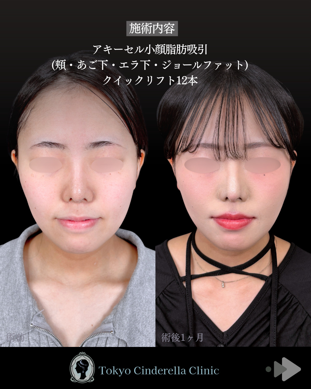 池袋院で行ったアキーセル脂肪吸引(頬・あご下・エラ下・ジョールファット) とクイックリフト12本整形で有名な名医の石井達也の症例写真