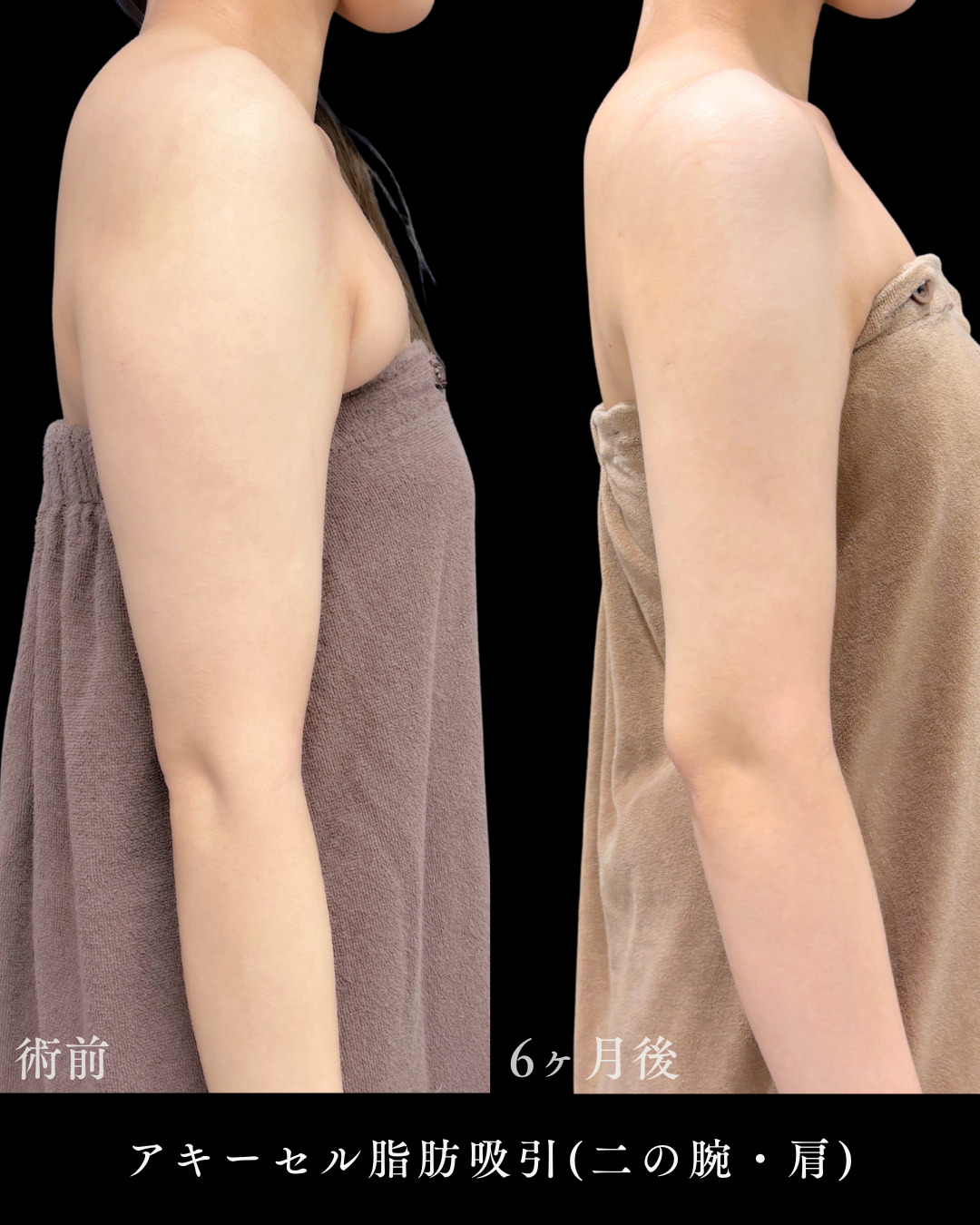 池袋院で行ったアキーセル脂肪吸引(二の腕・肩)とボツリヌス注射(肩)整形で有名な名医の石井達也の症例写真