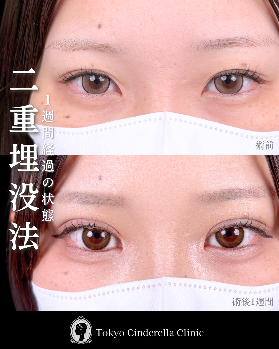 池袋院で行った韓国式自然癒着法4点整形で有名な名医の石井達也の症例写真