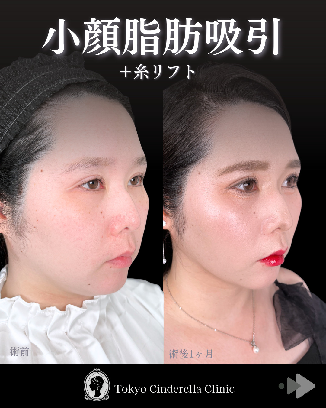 池袋院で行った小顔脂肪吸引（頬・あご下・エラ下・ジョールファット）とクイックリフト10本整形で有名な名医の石井達也の症例写真