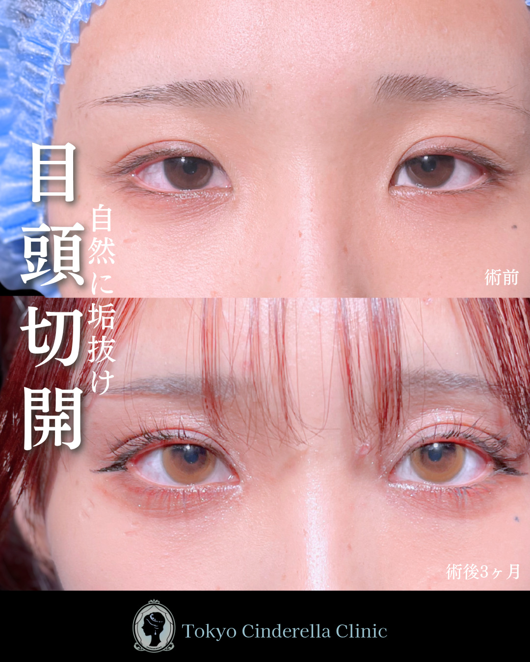 池袋院で行ったMD式目頭切開整形で有名な名医の石井達也の症例写真