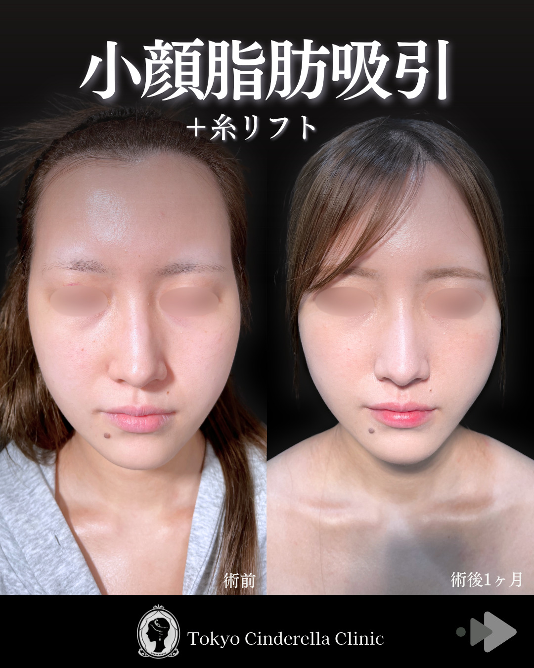池袋院で行ったアキーセル小顔脂肪吸引(頬・あご下・エラ下・ジョールファット) と糸リフト６本と他院修正整形で有名な名医の石井達也の症例写真