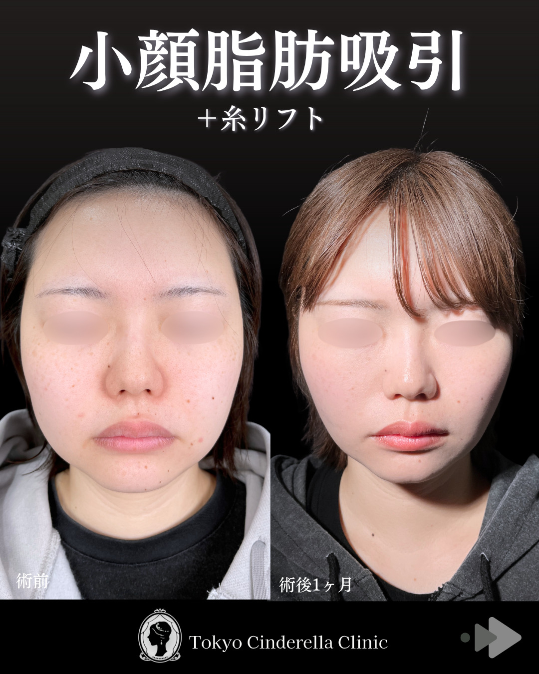 池袋院で行った小顔脂肪吸引(頬・あご下・エラ下)/クイックリフト 10本整形で有名な名医の石井達也の症例写真